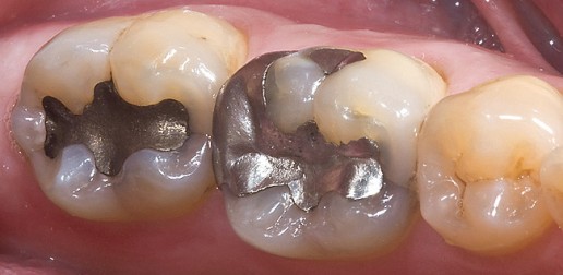 Restaurations dentaires - Amalgame
