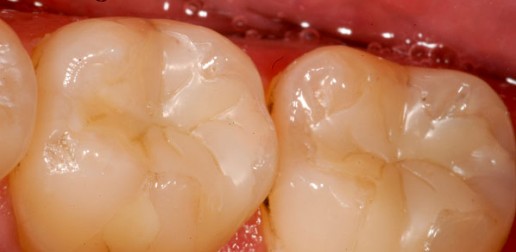 Restaurations dentaires - Composite