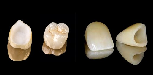 Restaurations dentaires - Couronnes en céramique